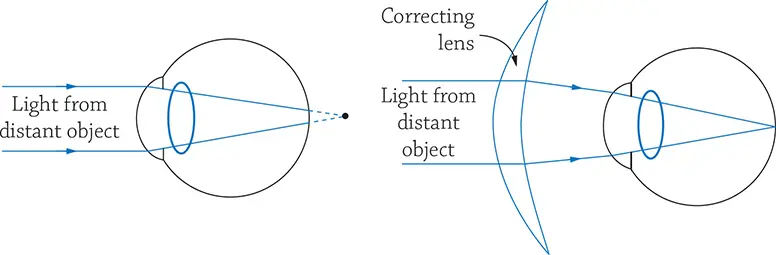 figure 2:  hyperopia & its correction with the convex lens