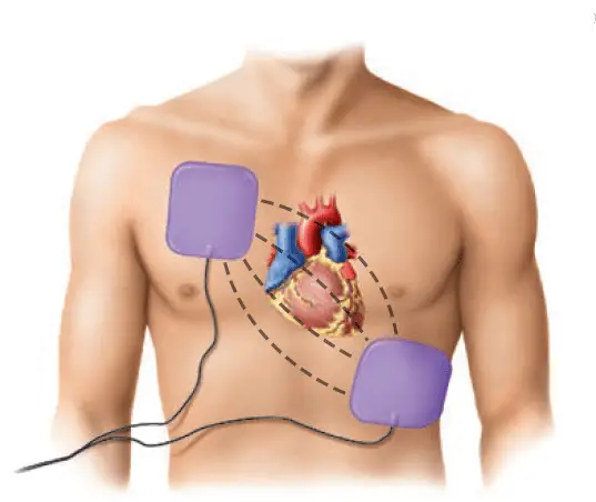 Defibrillator - application of Capacitors in the medical field
